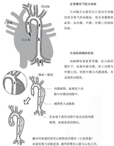 血管爆裂！大动脉剥离1